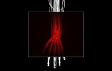 Carpal Tunnel Syndrome Treatment
