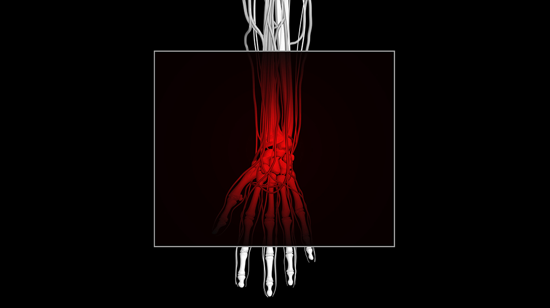 Carpal Tunnel Syndrome Treatment