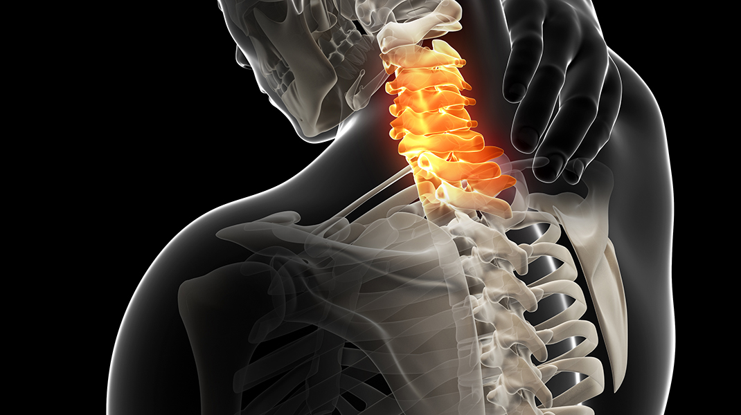 What is Spinal Decompression?