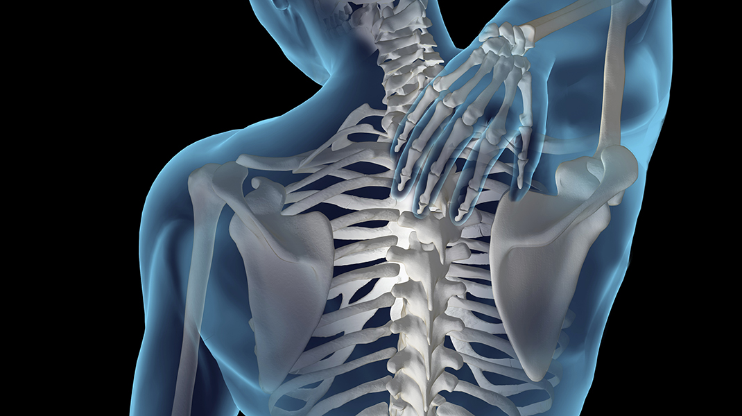 What is Scoliosis?